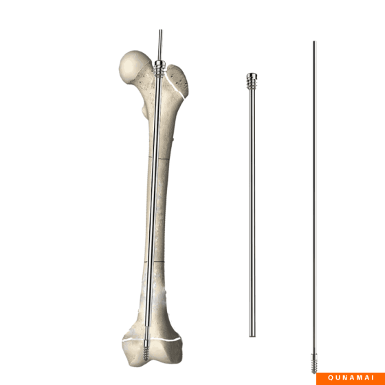 Telescopic Intramedullary Nail
